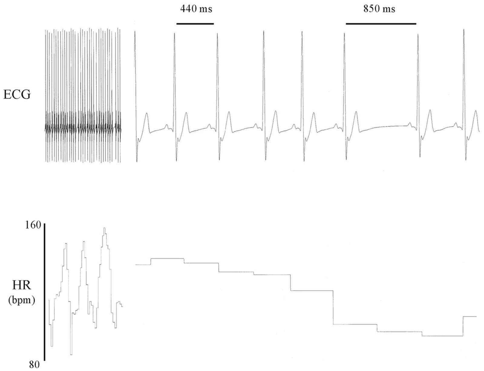 Tracé de variabilité de la fréquence cardiaque illustrant l'état de cohérence cardiaque